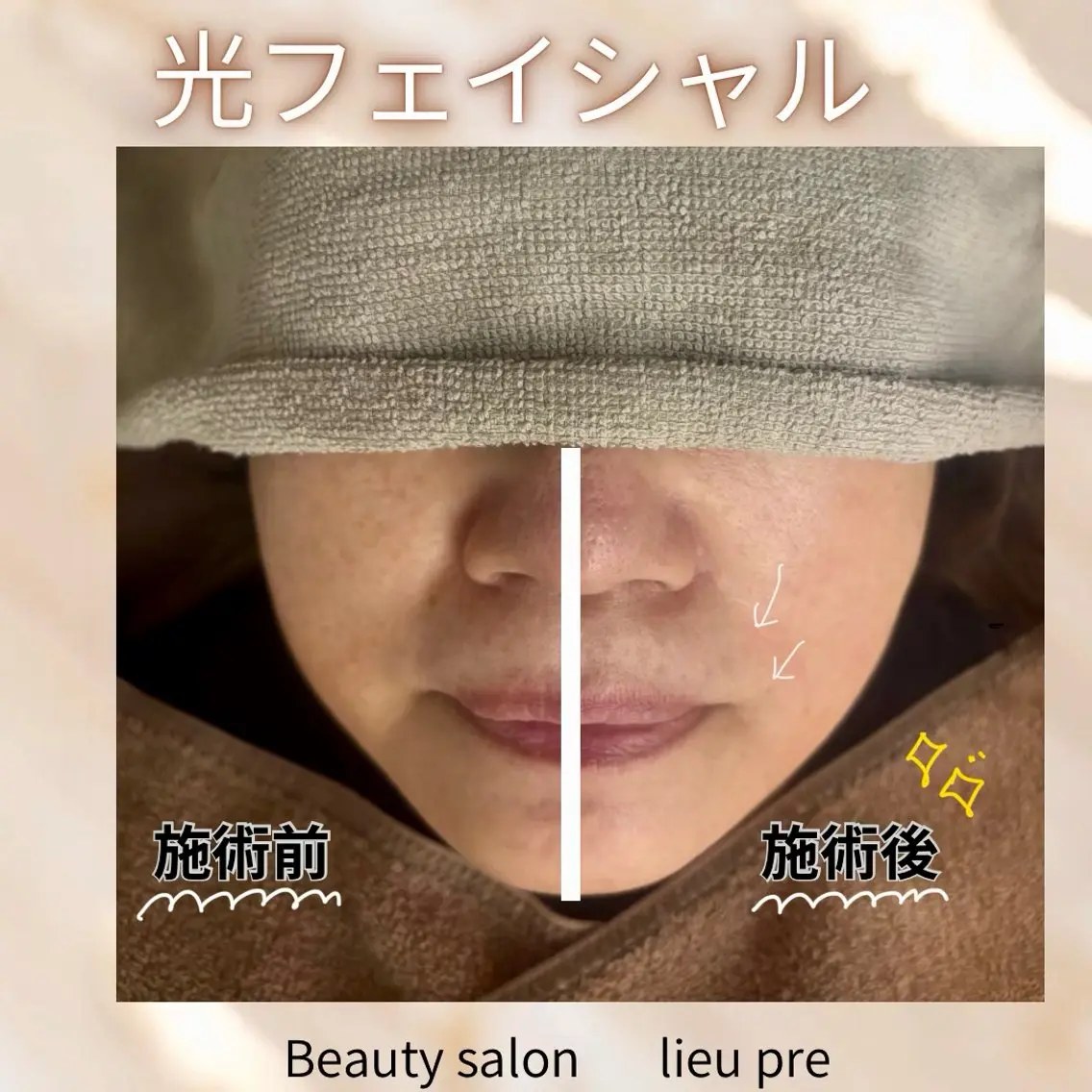 lieupré 脱毛 oshima‎⌣̈のエステ・リラクイメージ