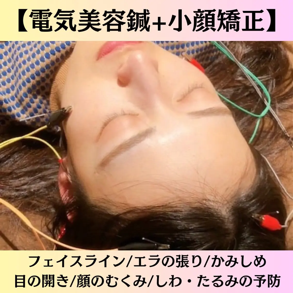 エイジングケア美容鍼【初めての方はこちら】の写真