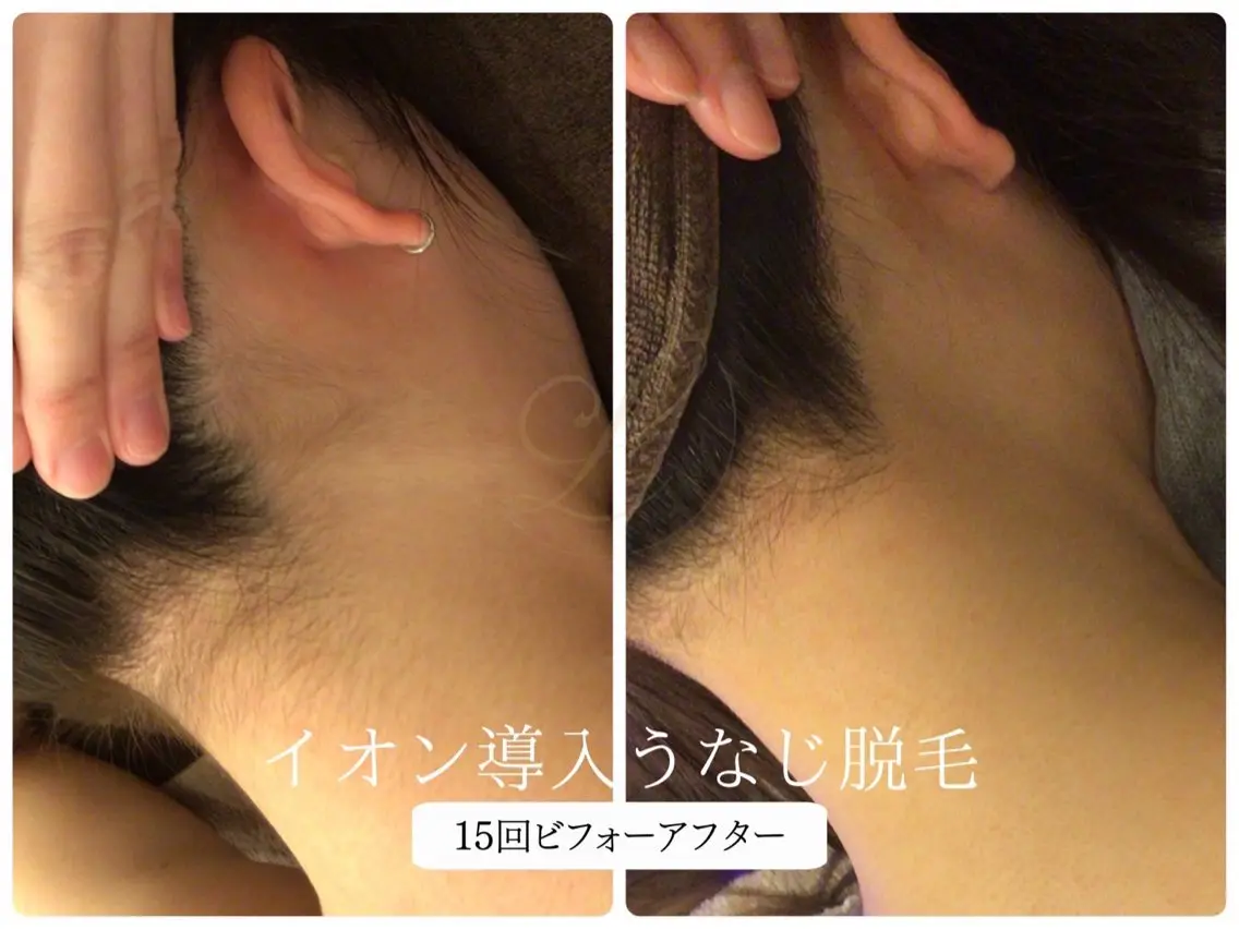 脱毛 🎀うなじ脱毛🎀 ㅣLino堀江のエステ・リラクイメージ