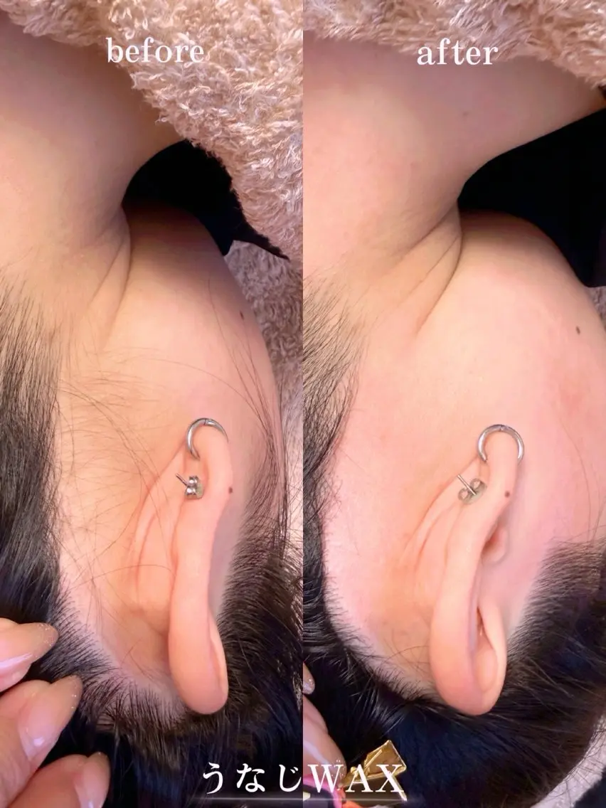 うなじWAX＋光脱毛🧖‍♀️の写真