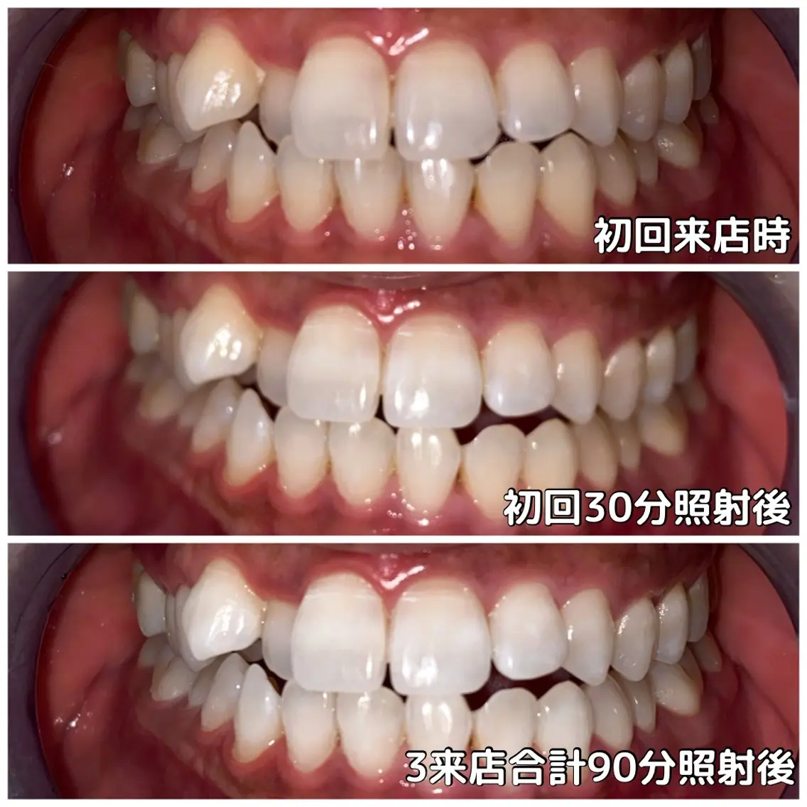 ✨🆕✨【 コスパ良く 短期集中で白くする 】一ヵ月集中コース 3来店合計90分照射の写真