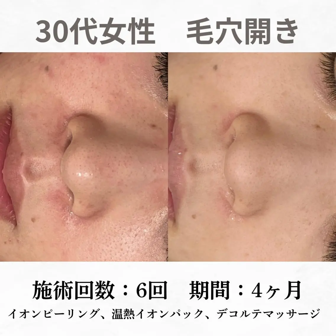重度ニキビ専門🌷 ダウンタイムなしのエステ・リラクイメージ