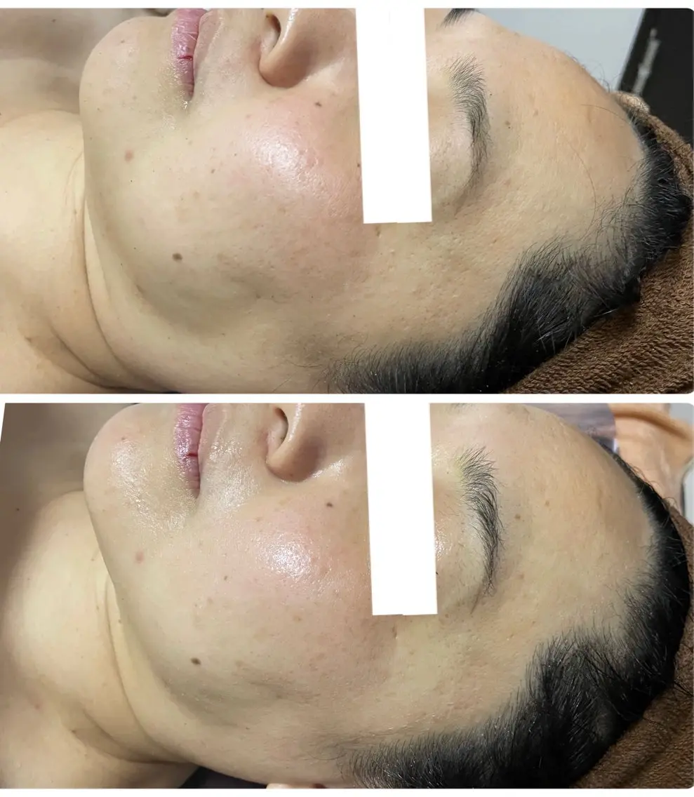 リフトアップ⤴️タルミに‼️サーマナイフ✨✨の写真