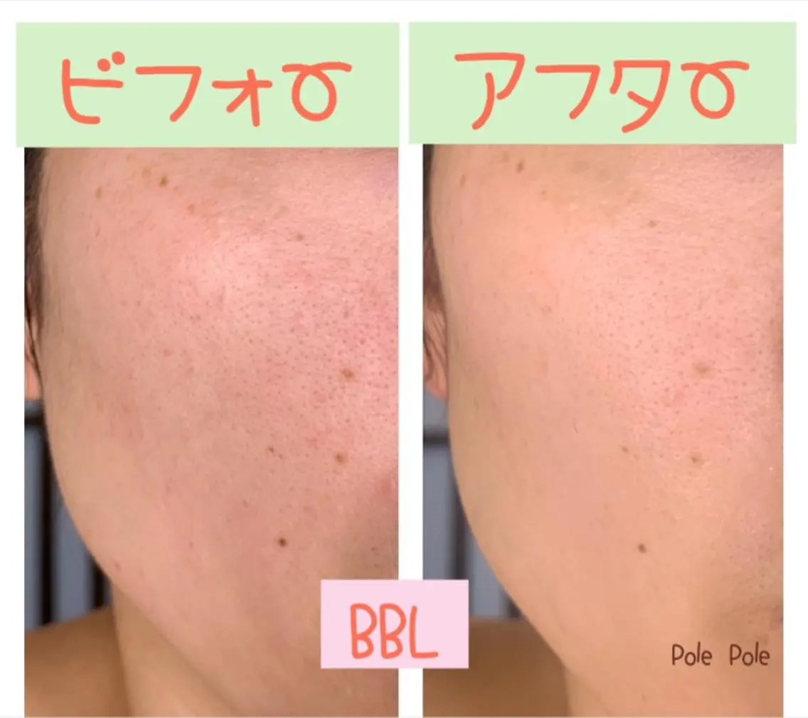 BBLフェイシャルの写真