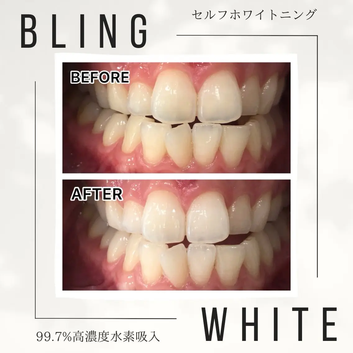 NEW OPENキャンペーン✨痛みシミなし・歯に優しい【短期集中美白一ヶ月3回コース】の写真