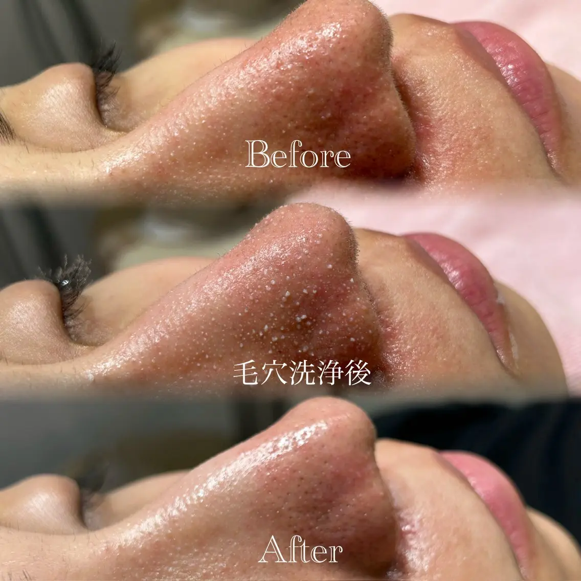【🌟大人気黒ずみ毛穴撃退🌟】顔+毛穴全体洗浄+ハイドロジェリーマスクの写真