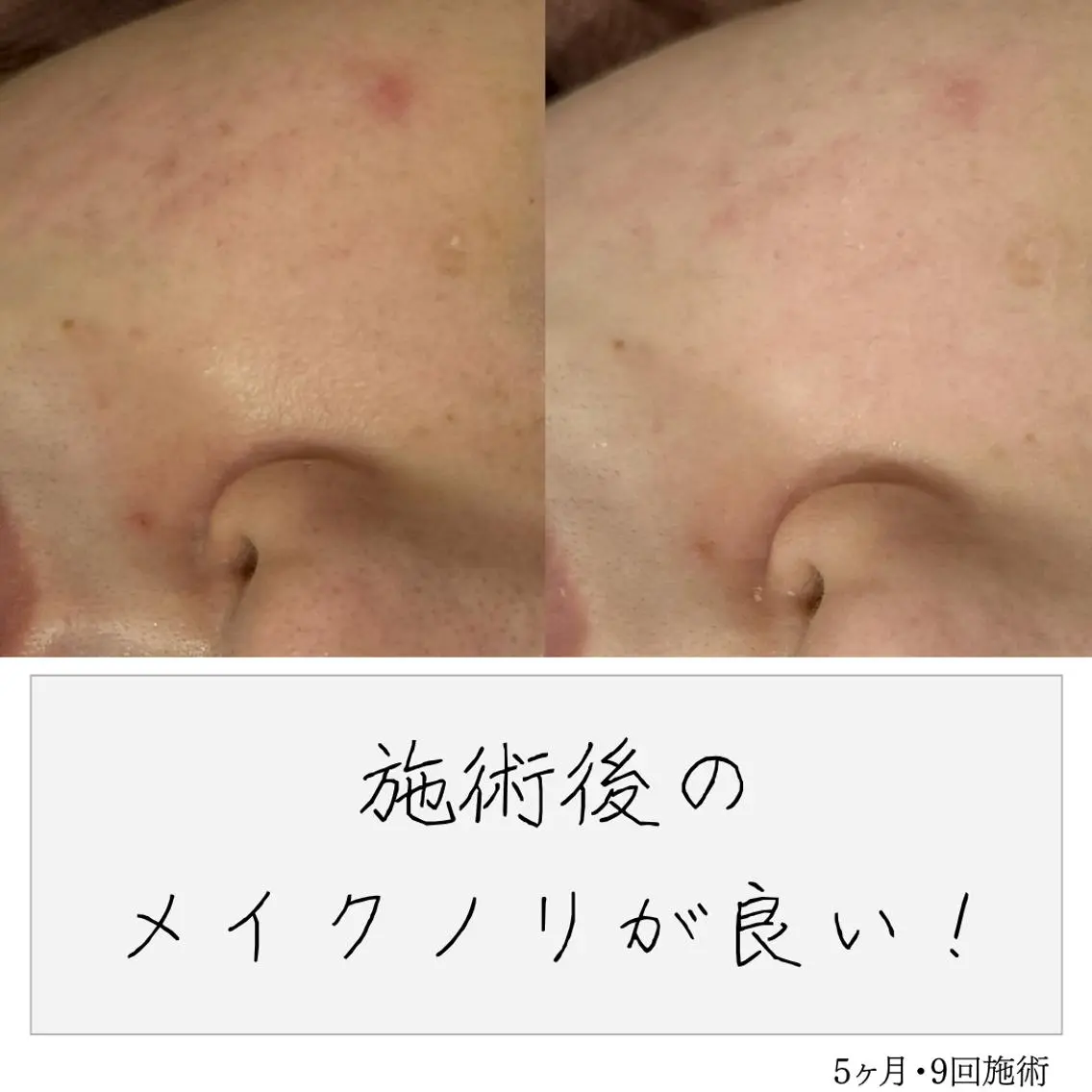 ニキビ経験者が施術 する専門サロン🌻のエステ・リラクイメージ