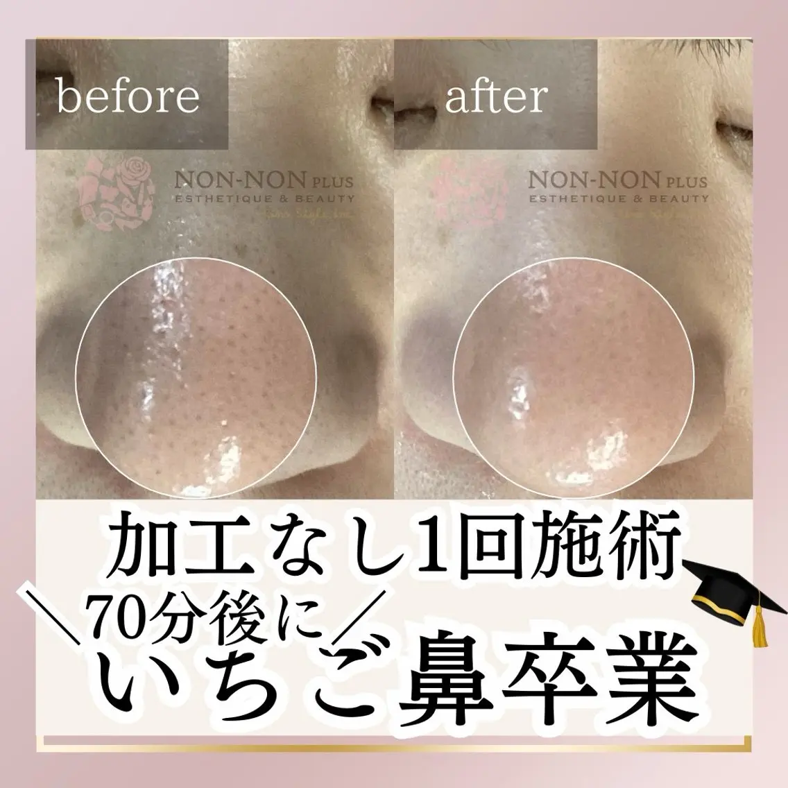 【技術ブラッシュアップの為のモニター】鼻の黒ずみ毛穴がツルツルに✨70分11,000円→今回2,200円💆♀️の写真