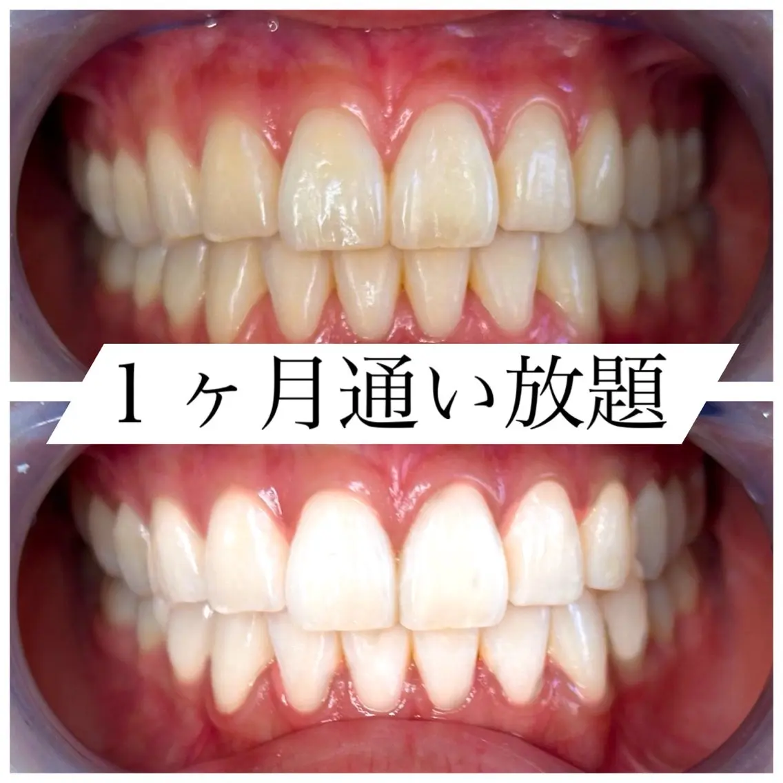 【1ヶ月通い放題】※初回のみ3回照射の写真