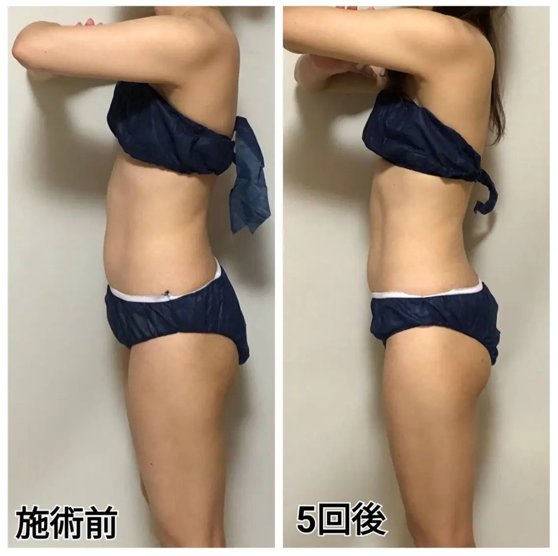 歯のホワイトニング＋寝るだけで脂肪撃退・筋肉増強セット💕の写真
