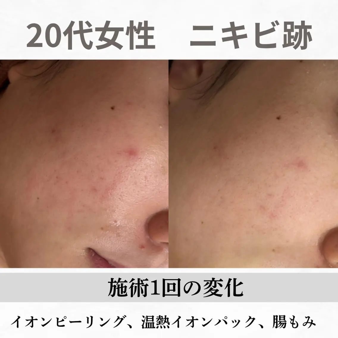 重度ニキビ専門🌼 ダウンタイムなしのエステ・リラクイメージ