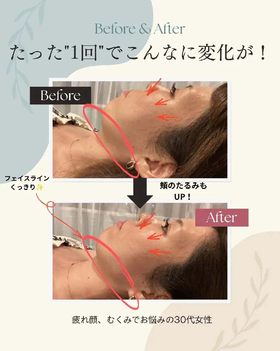 【平日限定★目元パッチリ】眼精疲労スッキリ美容鍼+お疲れ顔解消マッサージ(クマ・エラ・食いしばり)の写真