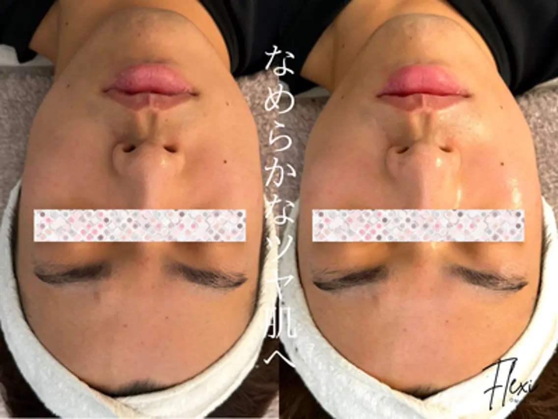 【メンズ美容】顔こり+肌ざらつき解消ピーリングコースの写真