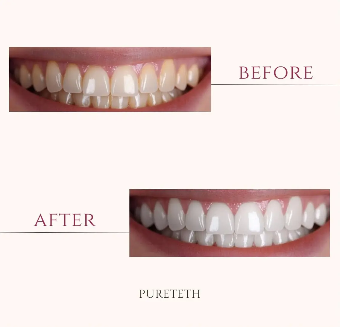 その他 ホワイトニングサロン PURETETHのエステ・リラクイメージ
