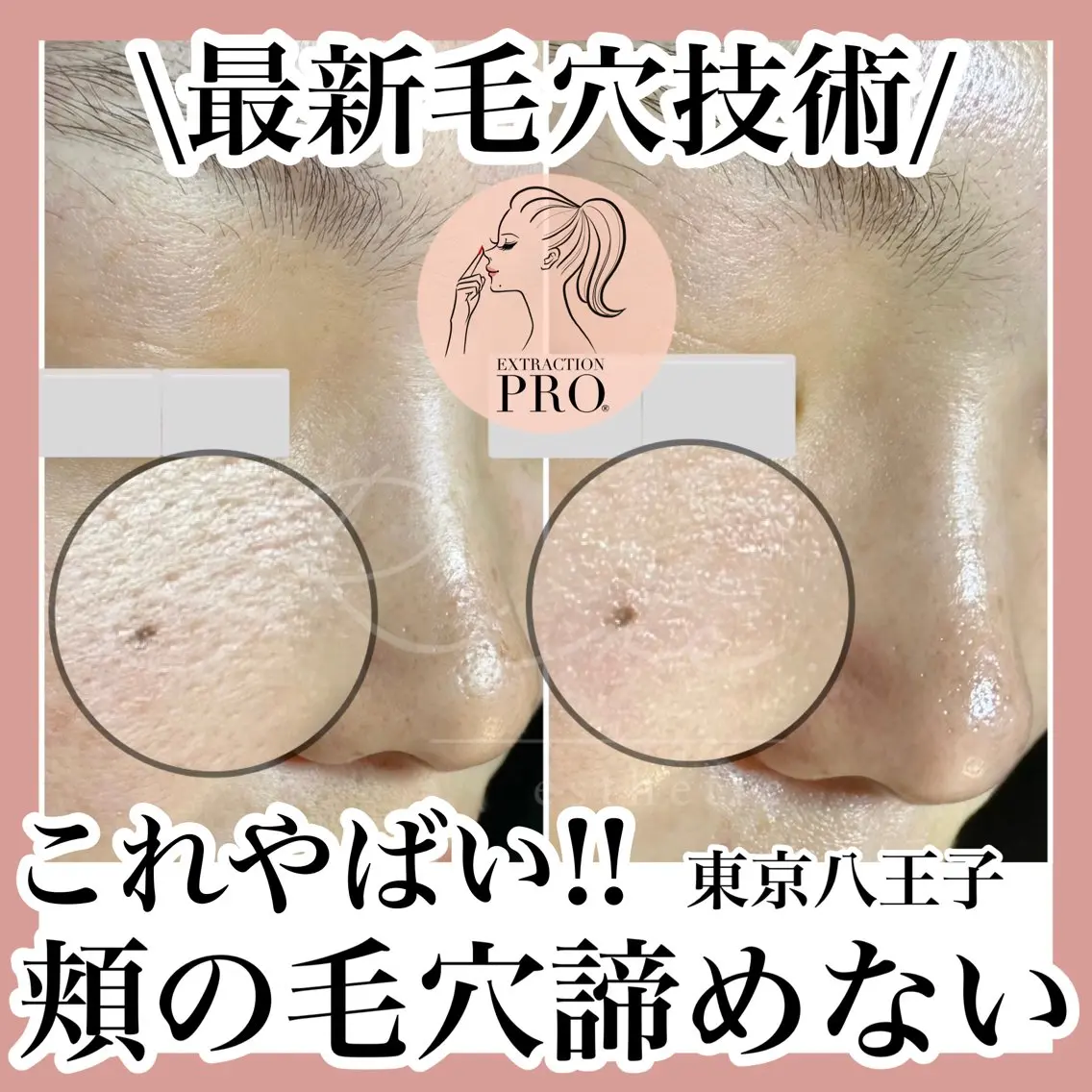 毛穴特化エステ -リールのエステ・リラクイメージ