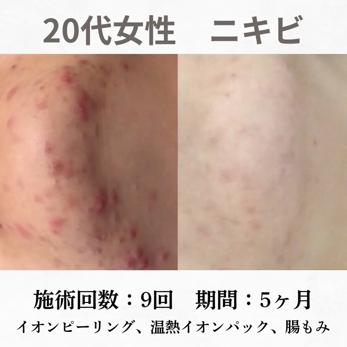 エステ リラク 繰り返すニキビ跡専門 根本改善のエステ・リラクイメージ