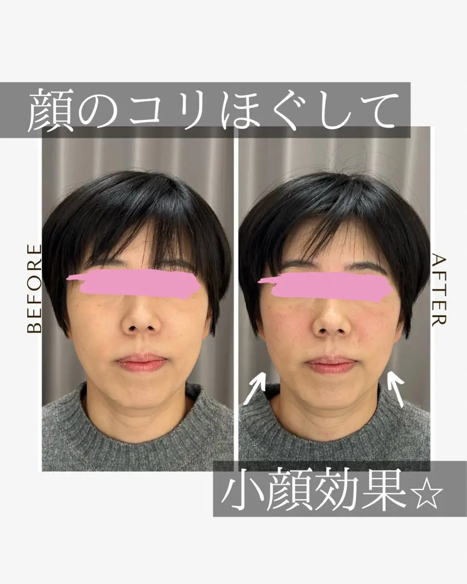 《美肌･小顔》美容鍼 ＆マッサージ＊MEIのエステ・リラクイメージ