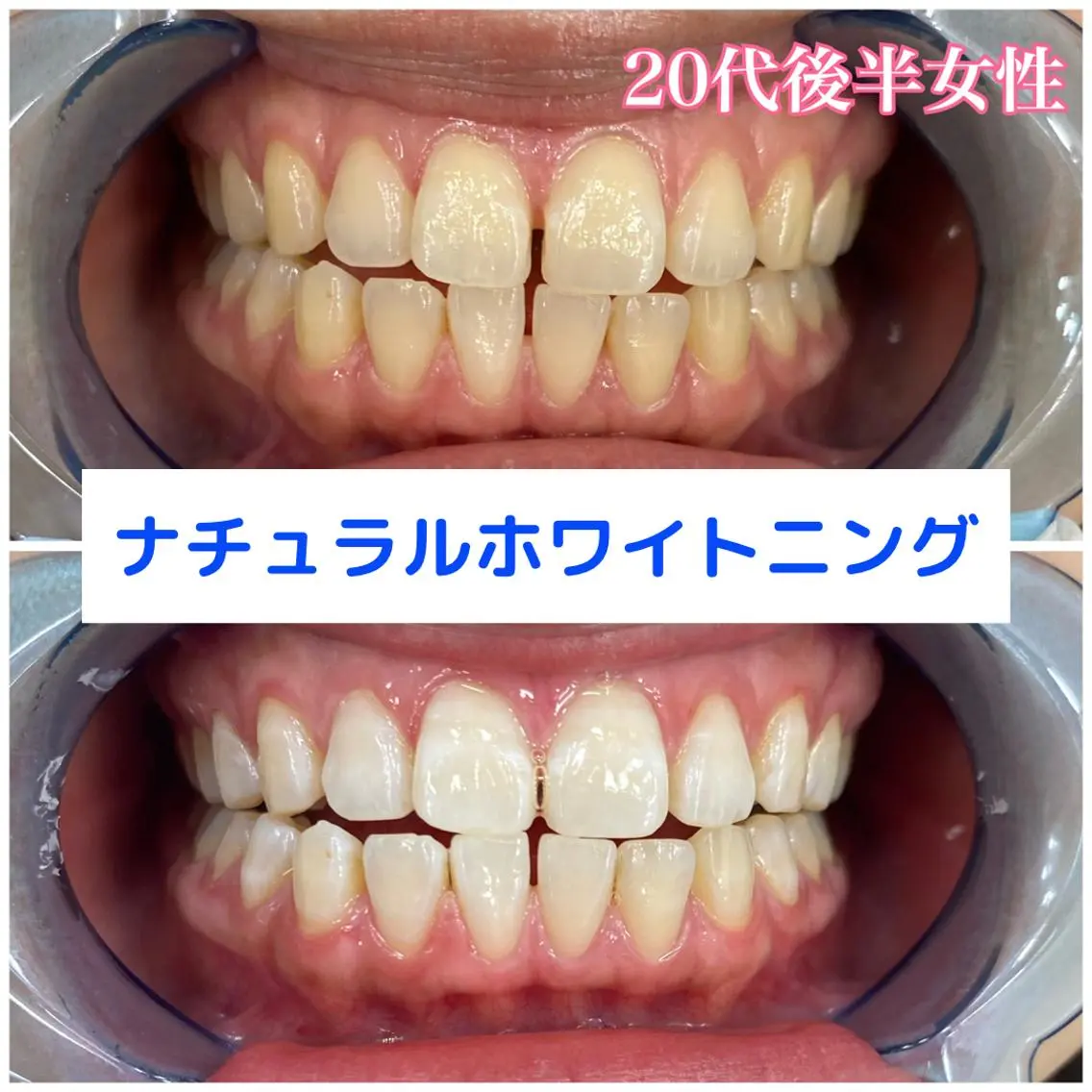 【初回限定・ナチュラルな白さ】人間本来の自然な歯の白さを目指していきます😁✨〈10分×3回コース〉の写真