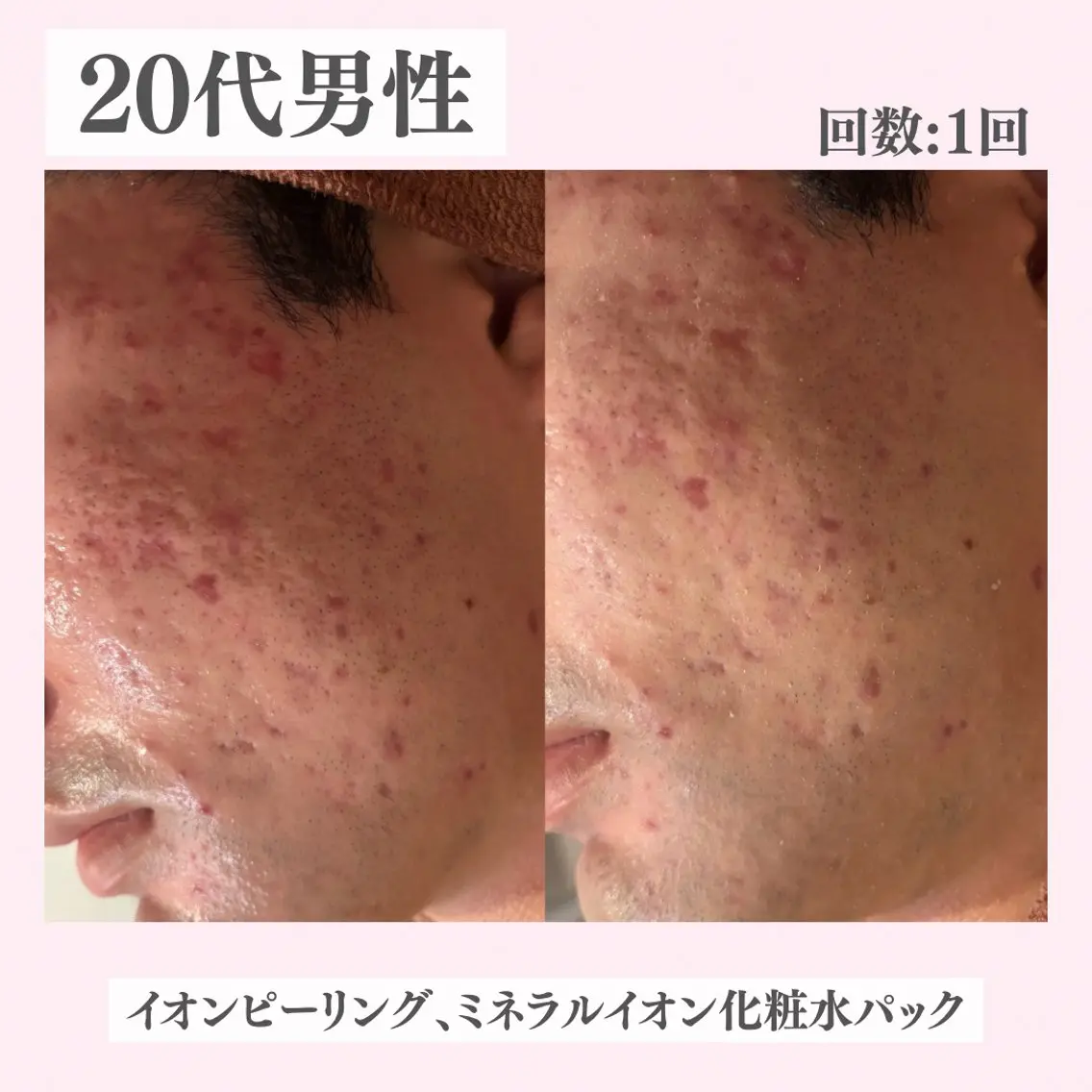 エステ リラク ニキビ・肌質改善専門 ♡人生が変わるサロンのエステ・リラクイメージ