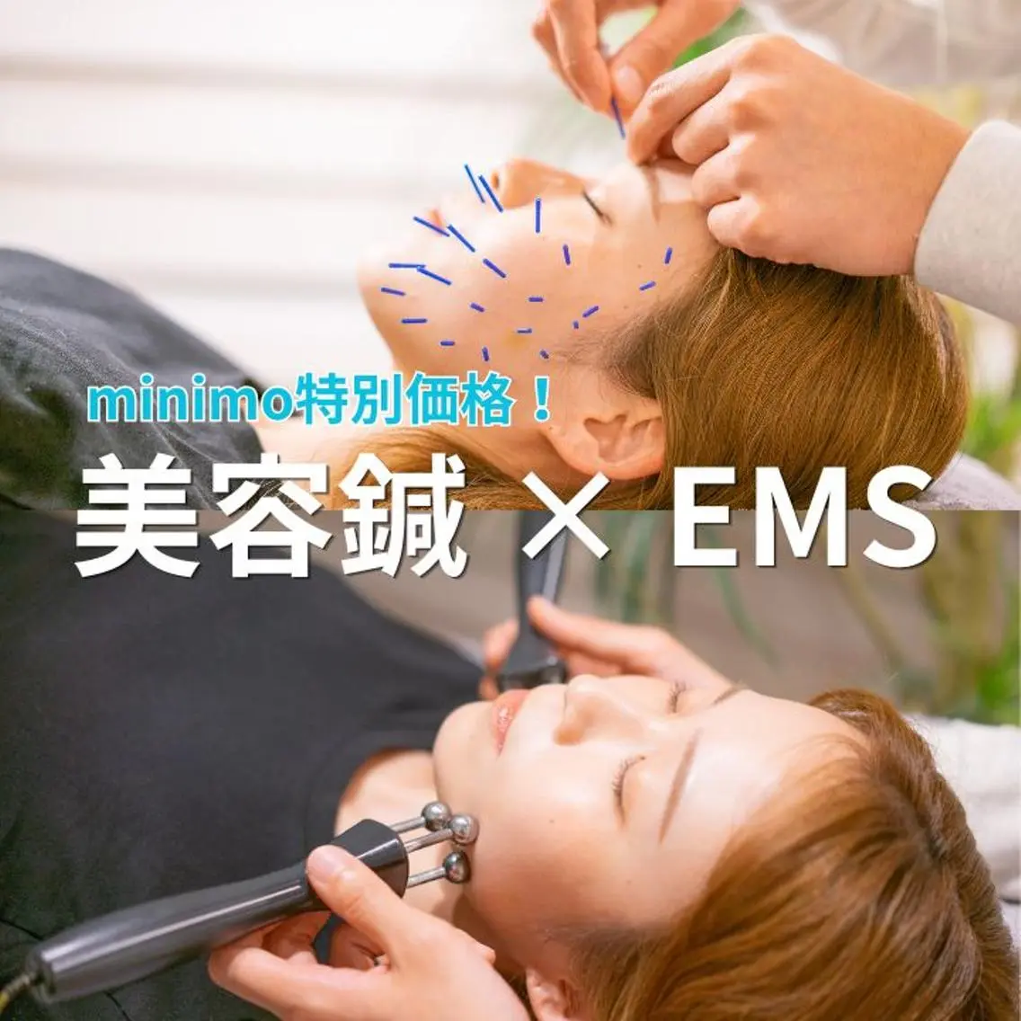 17日限定【美容鍼×小顔EMS】速攻リフトUP&むくみ解消!憧れの小顔&ツヤ肌に✨75分18,000円→4000円の写真