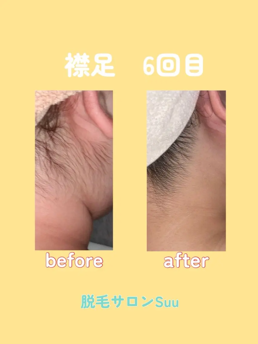 脱毛 上田 鈴華のエステ・リラクイメージ