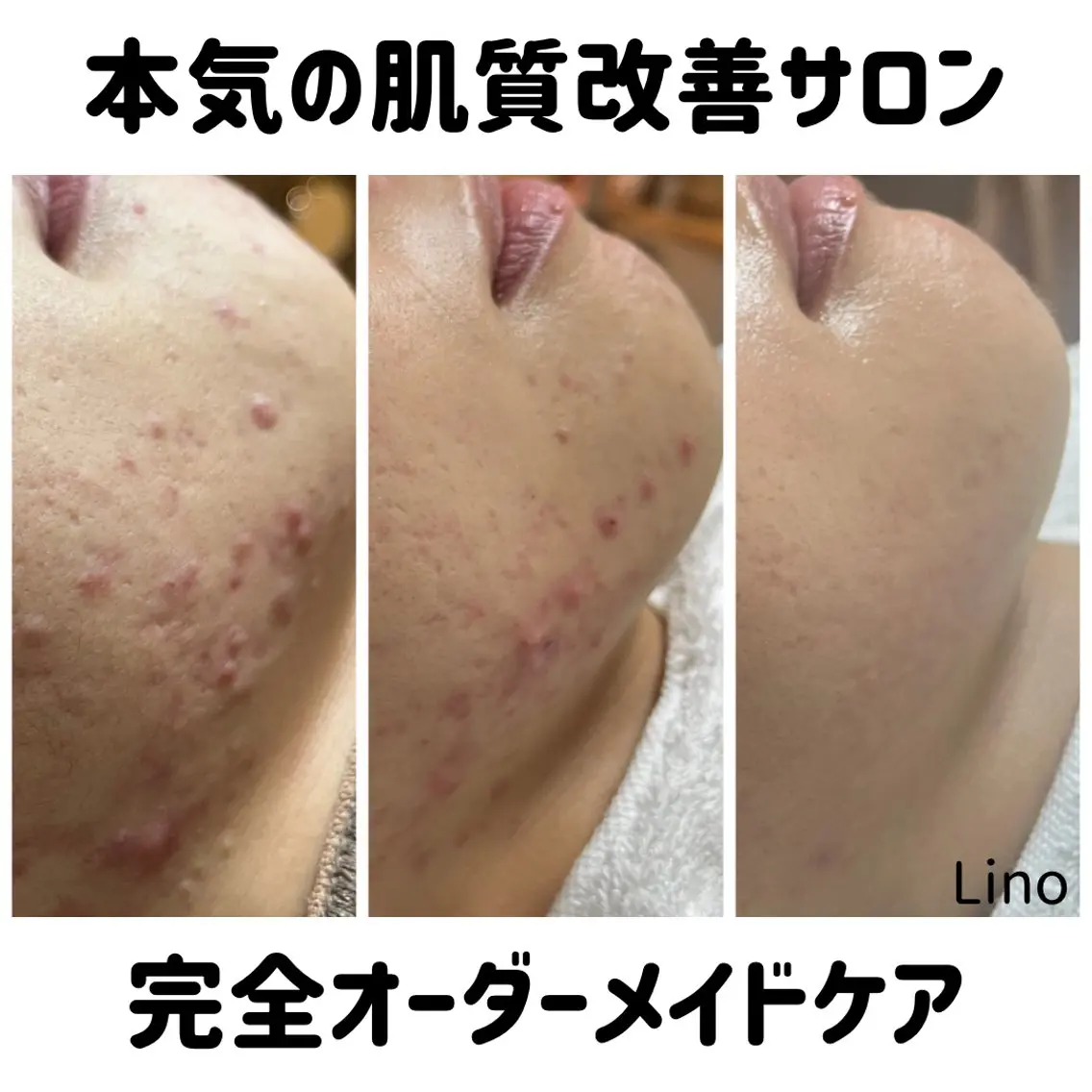 爆速の小顔と美肌♪ 平日限定★¥6600のエステ・リラクイメージ