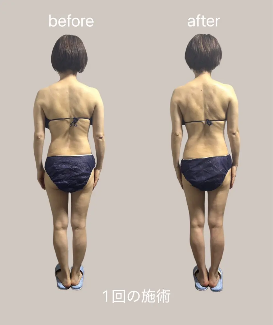 【2名限定/全6回】週1ペースでご協力いただける方⭐️夏までに美ボディ!全身筋膜リリース60分×6回 ¥35,000の写真