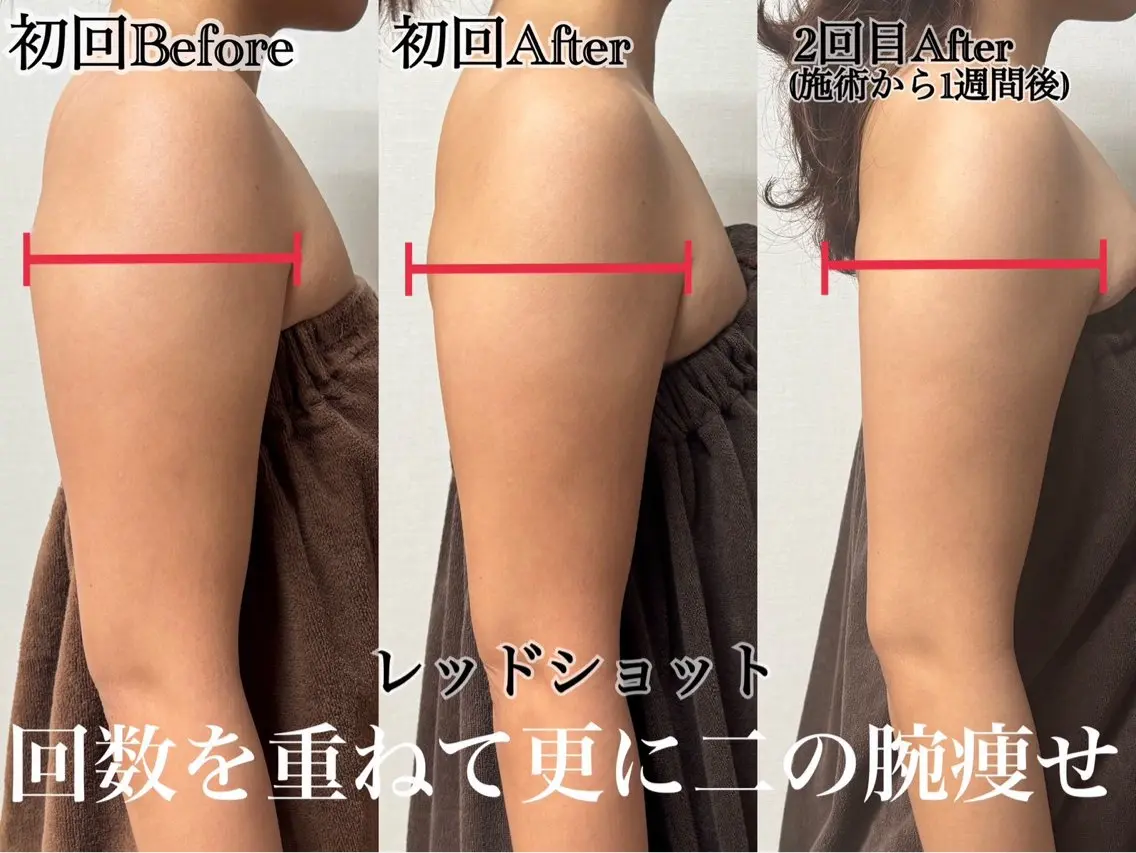 【最新美容🌟レッドショット💉❤️】すぐ実感できる韓国発🇰🇷脂肪撃退💕3cc導入で二の腕やお腹痩せ👊💥の写真