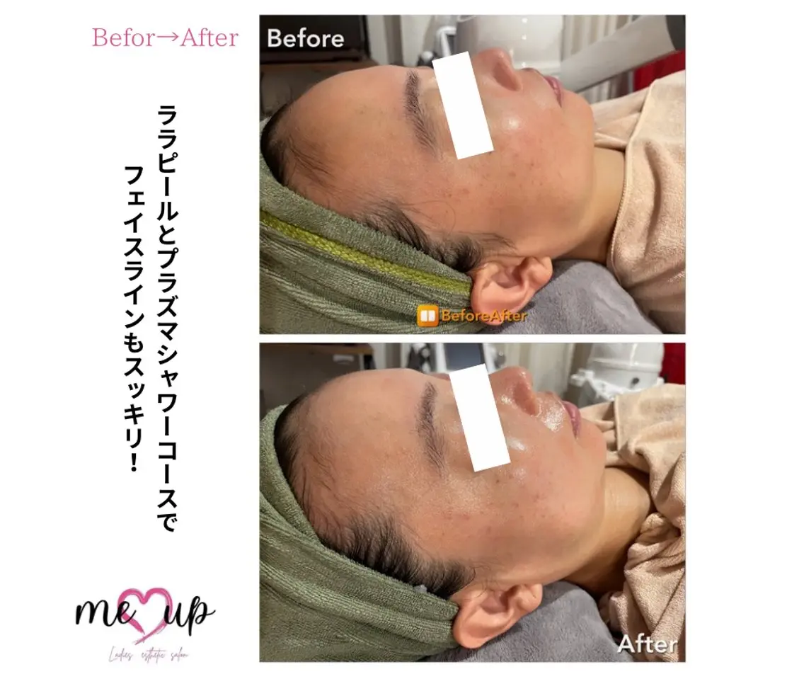 エステ Meupニキビ専門店 背中/ハーブ/肌管理のその他イメージ