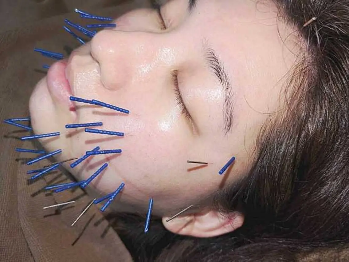 癒着剥がし美容鍼+小顔矯正の写真