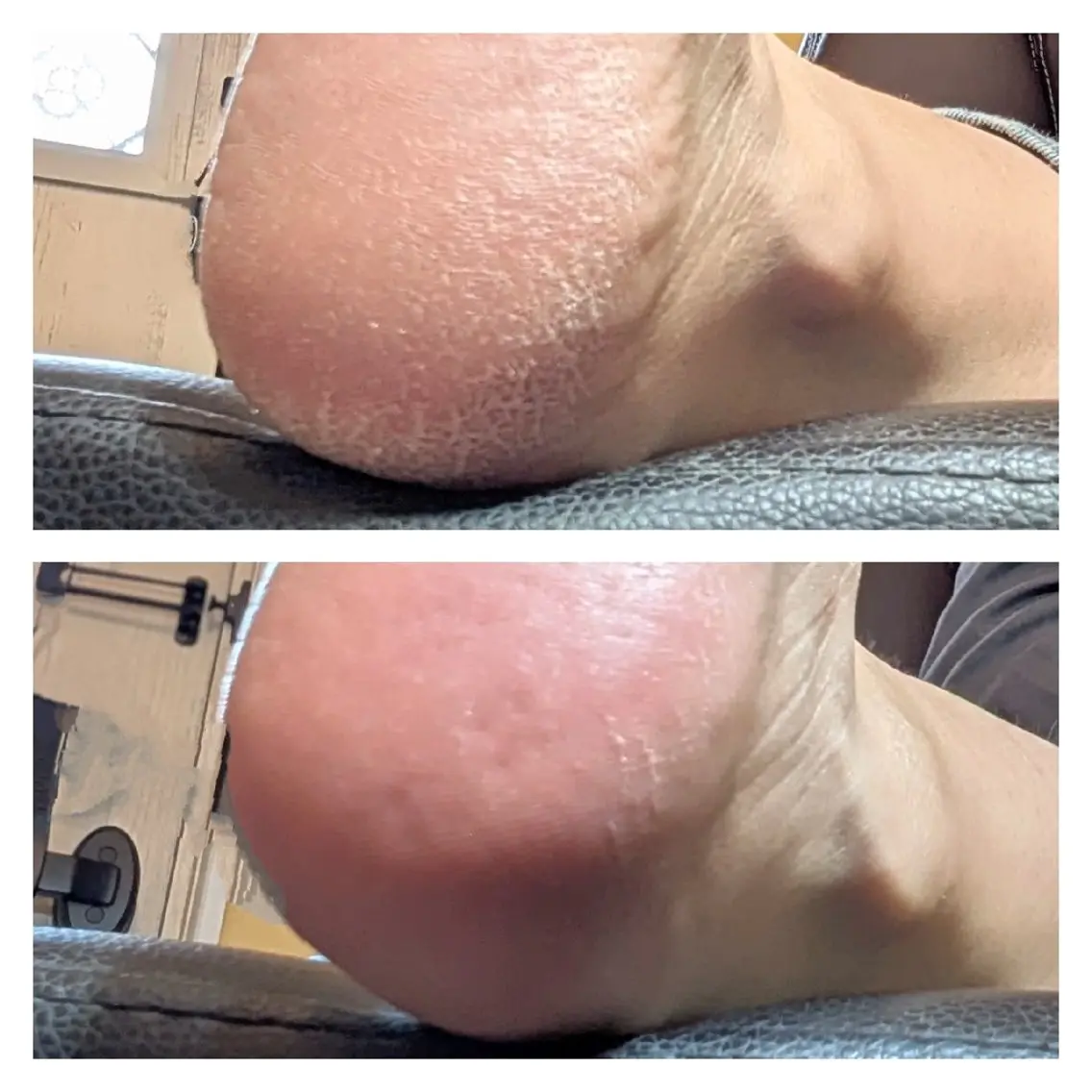 フット角質ケアの写真