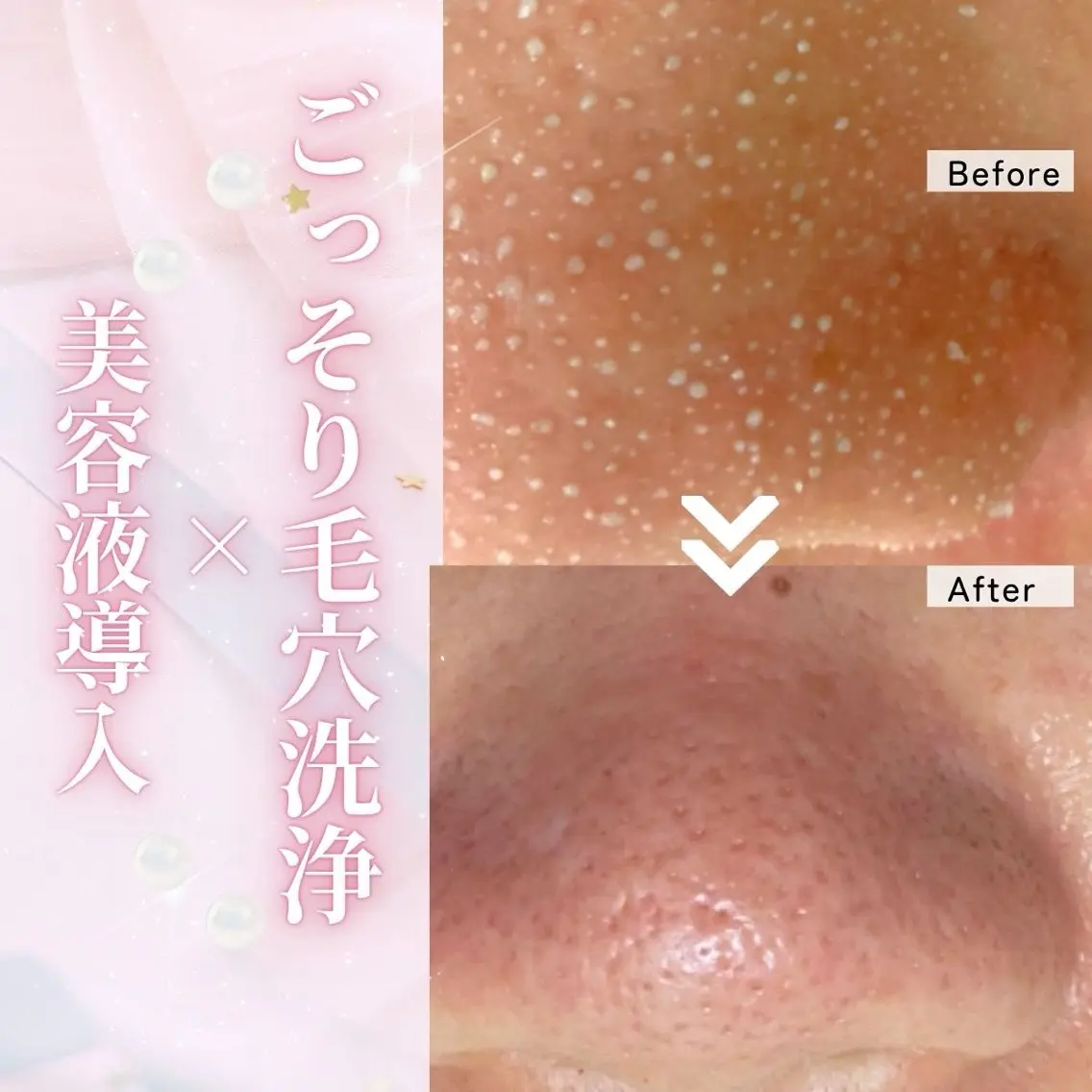〈毛穴洗浄×ララピール〉毛穴集中コースの写真