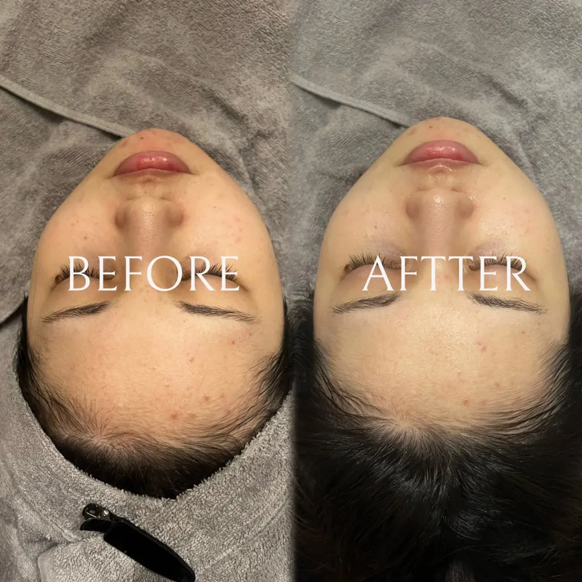 ［モニター限定📸］🔥minimo限定🔥50%OFF　ハーブピーリング＋LDMの写真