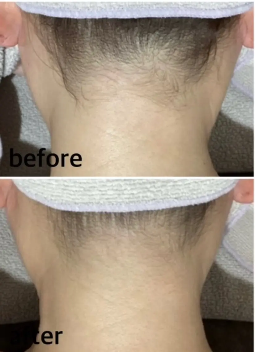 脱毛 Pullulant EstheKyotoのエステ・リラクイメージ