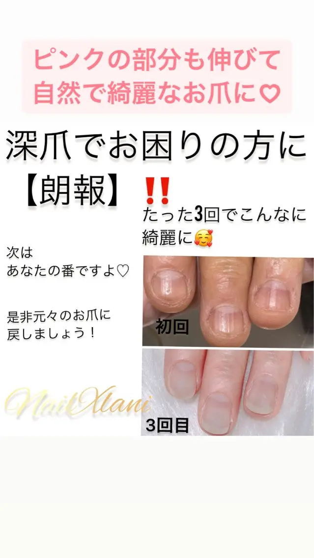 ネイル ハンドネイル Nail×Lani 深爪矯正対応◎のネイルデザイン