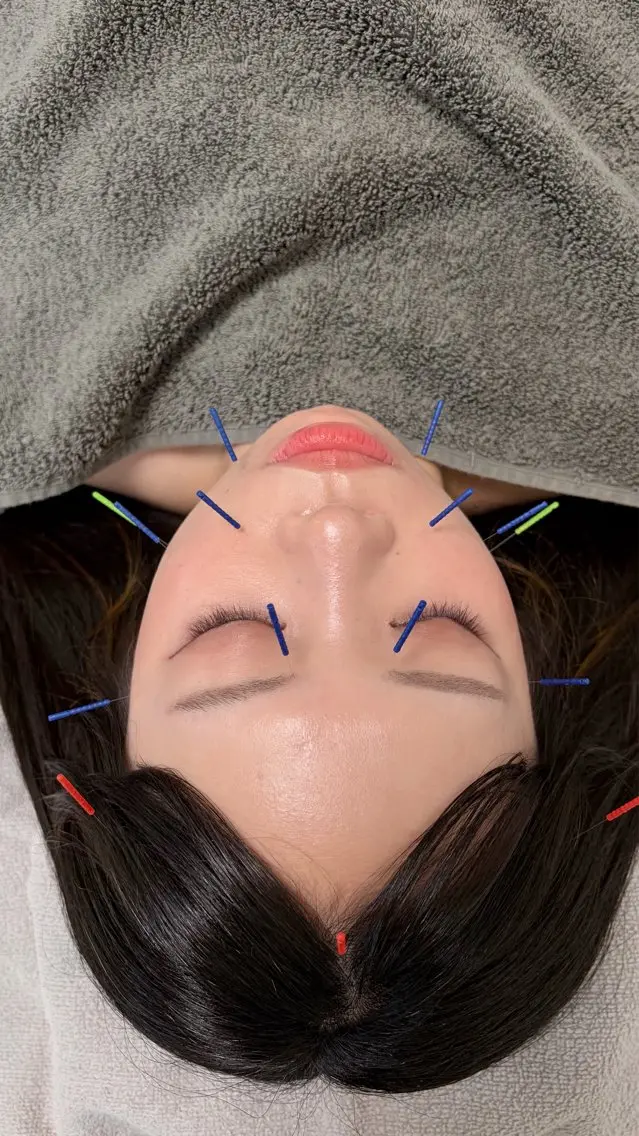 美容鍼の写真