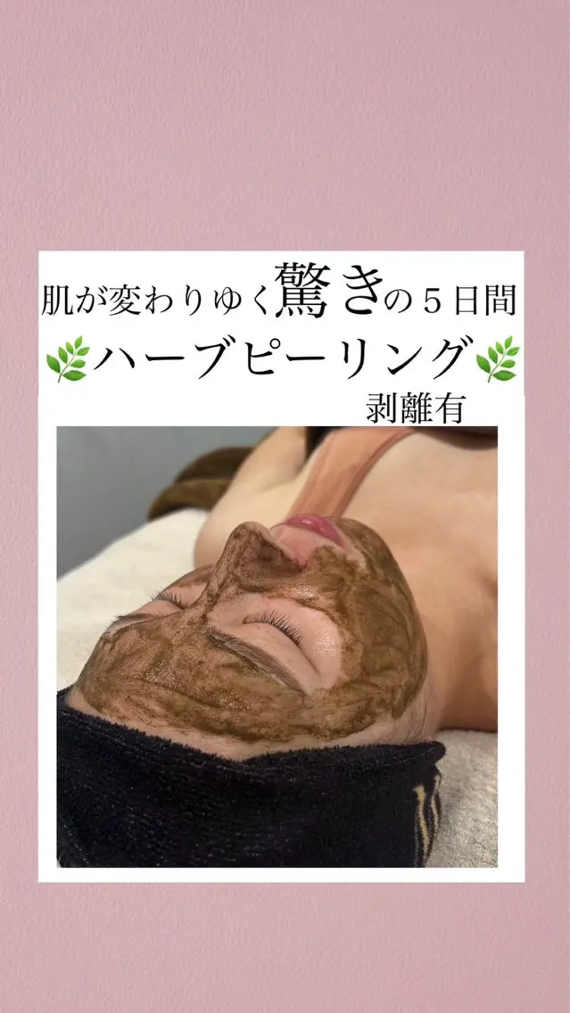【剥離有】🌿100%天然ハーブピーリング🌿陶器肌✨️ニキビ・ニキビ肌撃退!毛穴&黒ずみ&くすみケア✨️✨️の写真