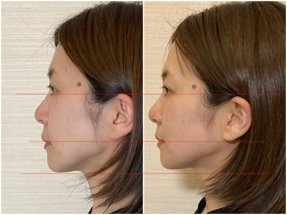 痛くない小顔調整+ヘッドスパ60分＊眼精疲労肩こりにもの写真