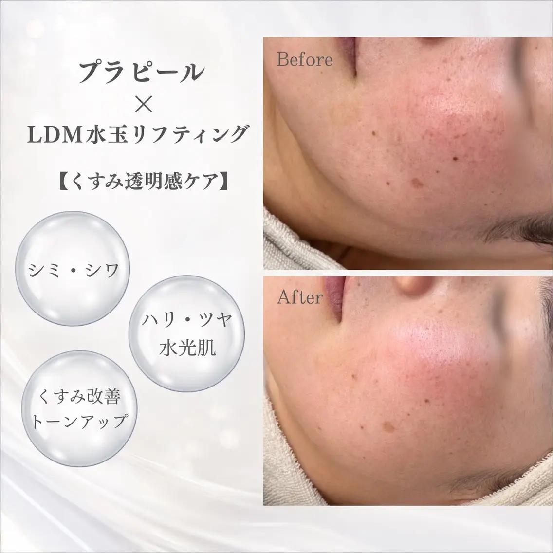 《透明感水光肌✨》プラピール+LDM水玉リフティング+プラズマニードル 【 保湿/くすみ/美白/シミ/肝斑ケア 】の写真
