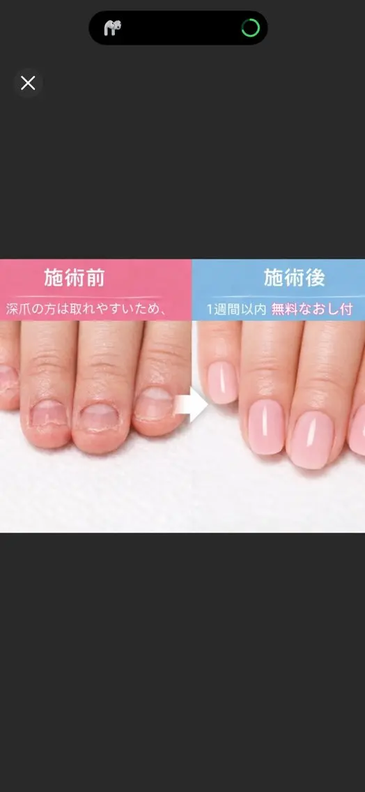 深爪改善コース(チップ長さだし10本)オフ無料の写真