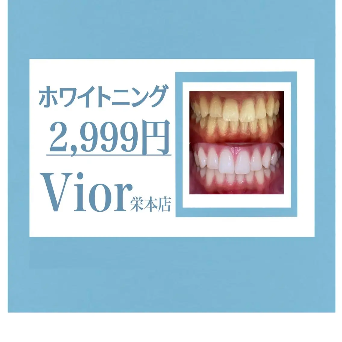 歯のセルフホワイトニング3回照射　(1回あたり999円)の写真
