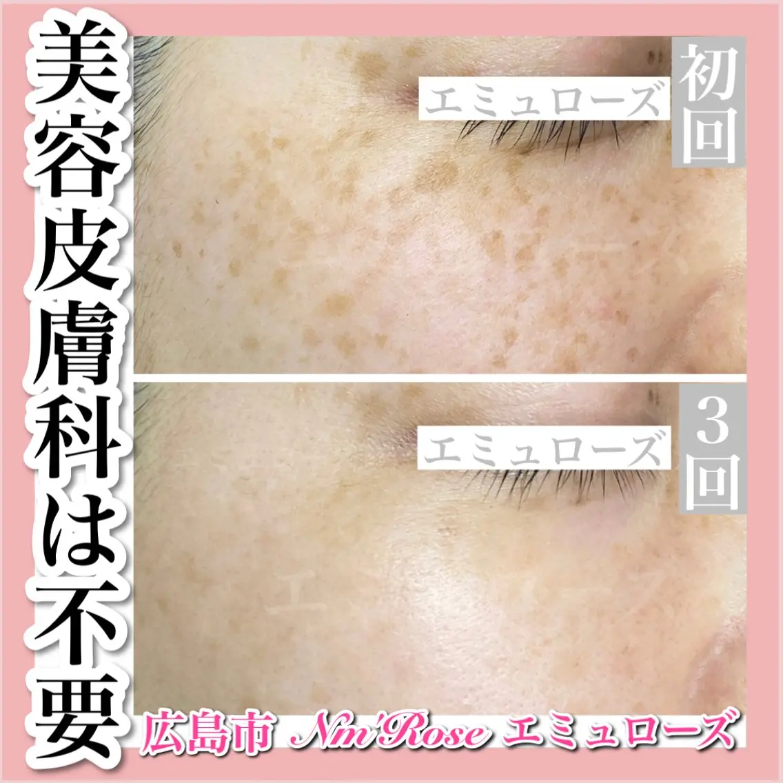当店人気No. 1《光打ち放題》シミ・くすみ・ニキビなど肌悩み全解消！の写真