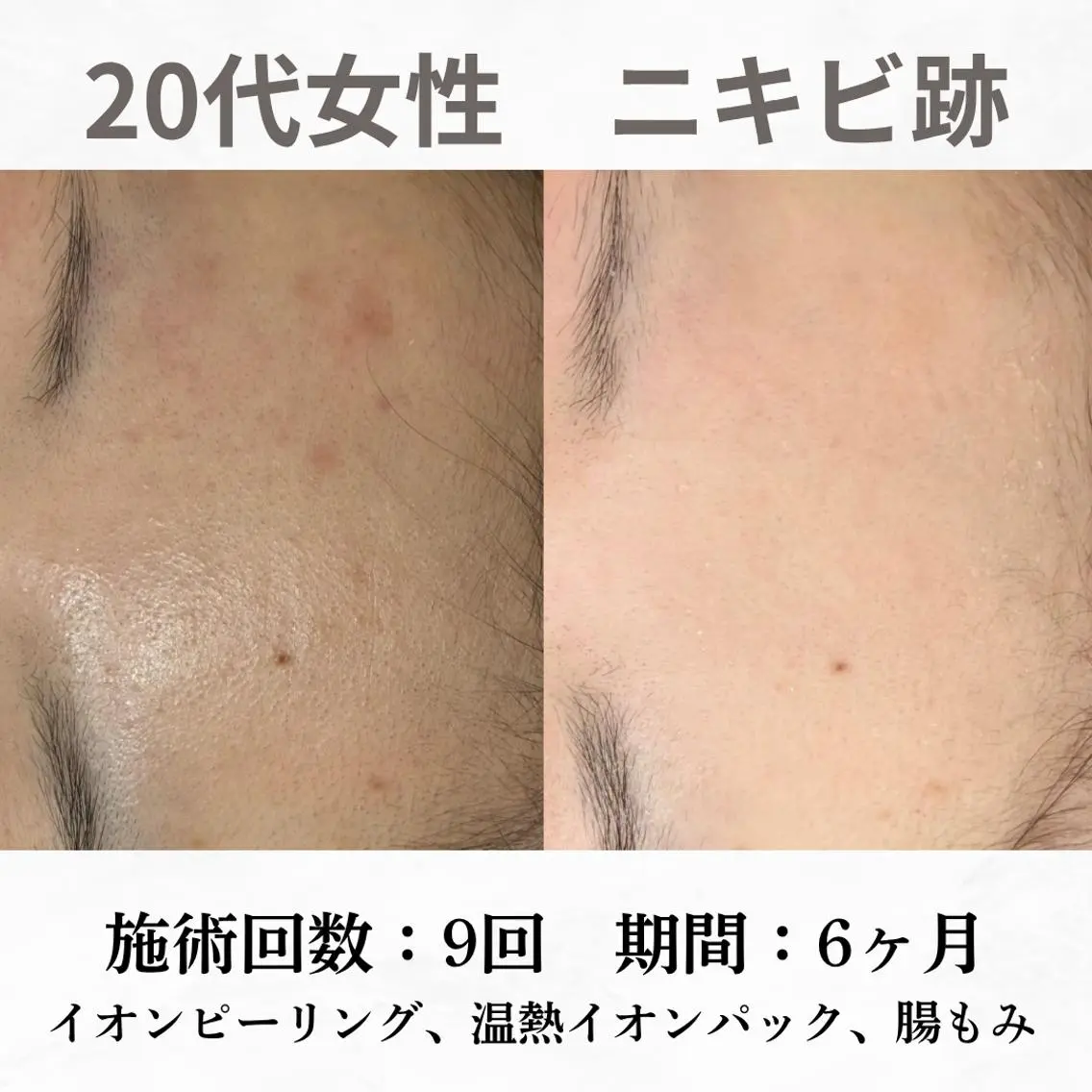 重度ニキビ専門🌼 ダウンタイムなしのエステ・リラクイメージ