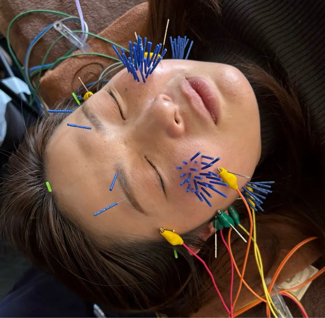 【1月 キャンペーン 残り3名】エラ張り・食いしばり撃退！美容鍼の写真