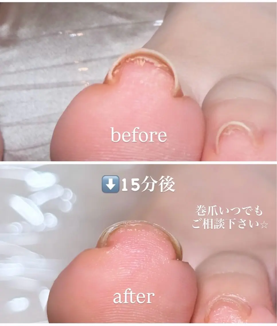 痛くない巻爪システム！ヘイスイッチの写真