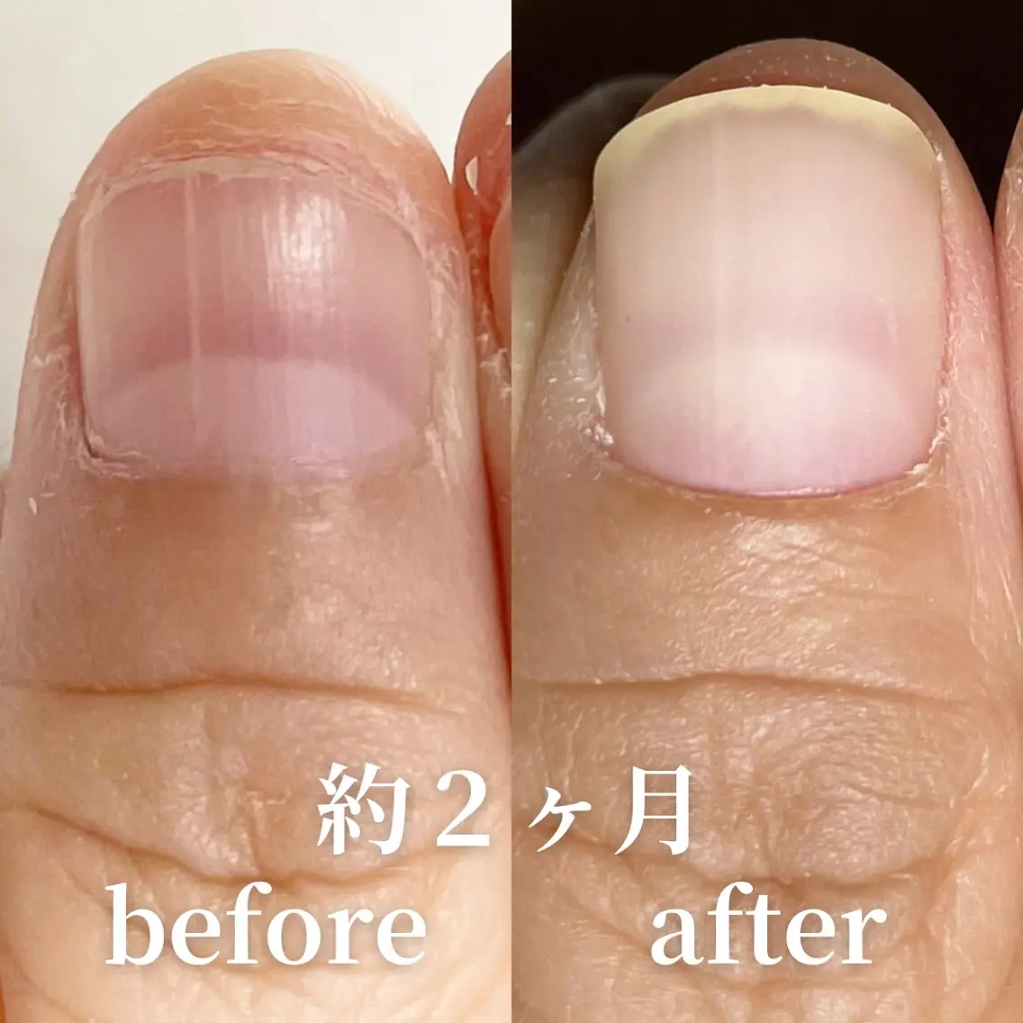 本気で悩んでいる方限定!深爪育成コースの写真
