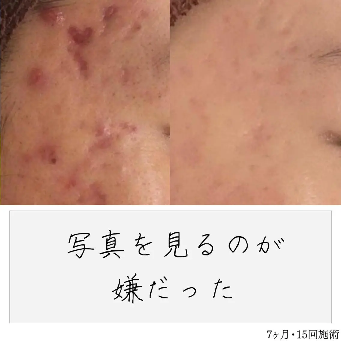 ニキビ経験者が施術 する専門サロン🌻のエステ・リラクイメージ