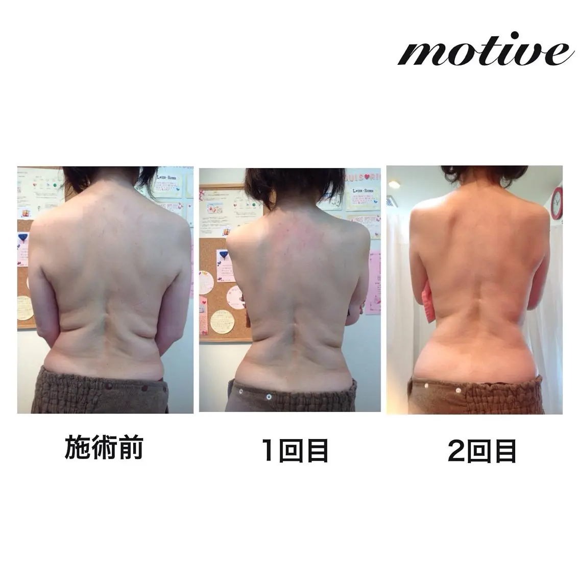 【minimo限定】人気メニュー‼️ボディラインをくっきりさせたい方へmotive痩身ジェルくびれ体験✨️の写真