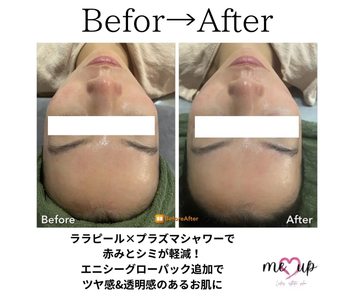 エステ Meupニキビ専門店 背中/ハーブ/肌管理のその他イメージ