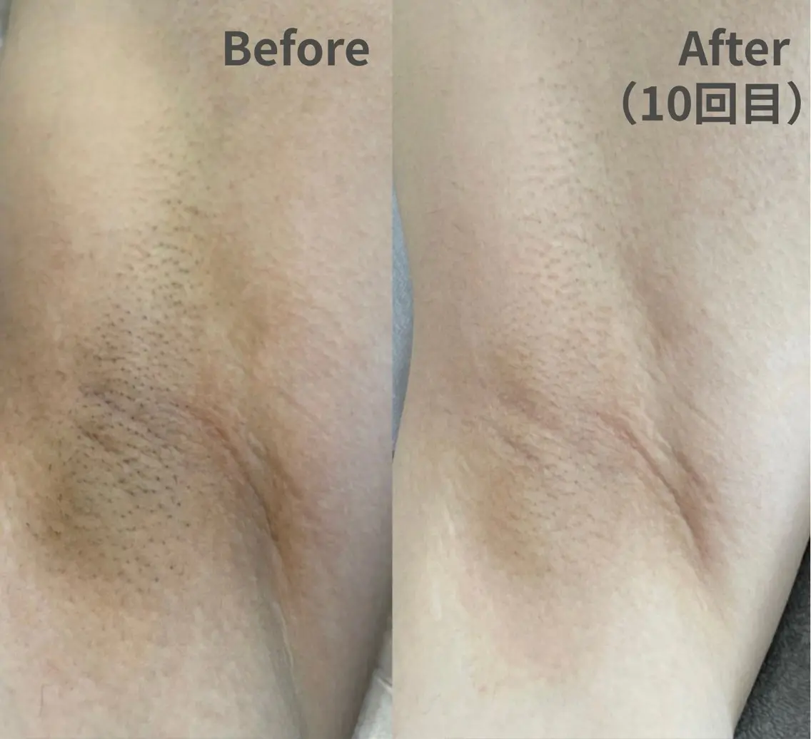 【夏の露出前に】効果重視！脇＋両腕つるすべ脱毛 ￥3,300の写真